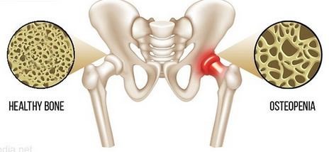 Osteoporosis - Monisha Mantra